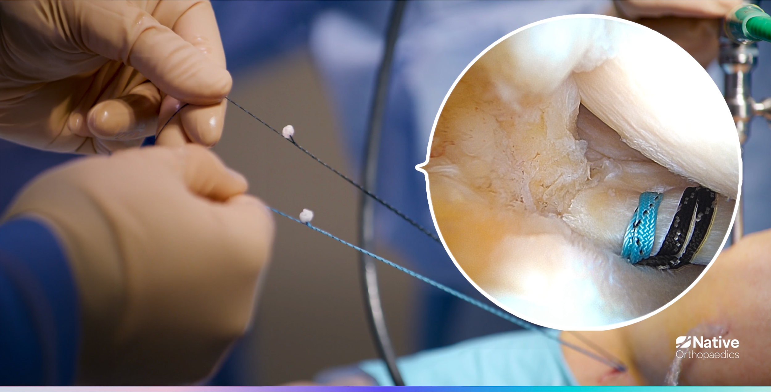 Surgical Technique | Native Orthopaedics